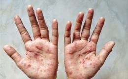 Số ca mắc bệnh đậu mùa khỉ trên toàn thế giới vượt 70.000 ca