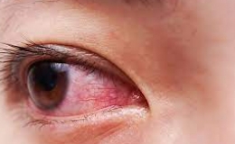 Cách phòng, ngăn ngừa lây lan bệnh đau mắt đỏ