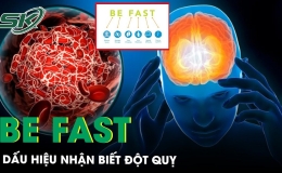 Dấu hiệu nhận biết bệnh nhân đột quỵ BE FAST