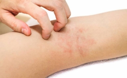 8 lời khuyên giúp phòng ngừa viêm da cơ địa mùa khô hanh