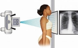 Nghiên cứu đầu tiên trên thế giới về ứng dụng AI trong chụp X-quang ngực