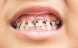 Dấu hiệu cảnh báo cơ thể thiếu canxi