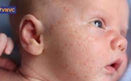 Tìm hiểu thông tin về bệnh sởi từ các nguồn đáng tin cậy