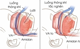 Ngủ ngáy - dấu hiệu cảnh báo bệnh nguy hiểm