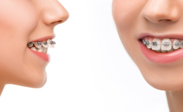 Nha khoa Sing - Địa chỉ niềng răng uy tín hàng đầu tại Hà Nội