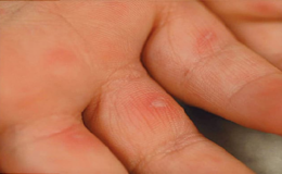 Bệnh tay chân miệng: Nguyên nhân, triệu chứng và các biện pháp phòng ngừa