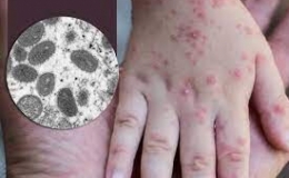 WHO: Bệnh đậu mùa khỉ không còn là tình trạng khẩn cấp y tế toàn cầu