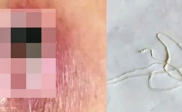Bệnh giun rồng tái xuất do ăn gỏi cá, ếch, rắn chưa nấu chín nguy hiểm như thế nào?