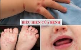 Bệnh tay chân miệng: Dấu hiệu nhận biết và nguồn truyền bệnh