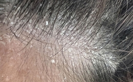 Gội đầu xong vẫn có gàu: Có phải bạn đang chọn sai dầu gội trị gàu?