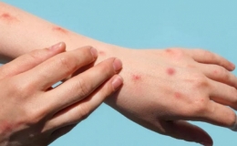 Đông Nam Á phát hiện ca đậu mùa khỉ đầu tiên, Việt Nam siết chặt kiểm dịch tại cửa khẩu