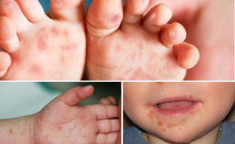 Phân biệt loét miệng với bệnh tay chân miệng, lưu ý khi chăm sóc trẻ tại nhà
