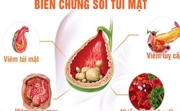 Sỏi tiết niệu và sỏi mật - Bạn cần biết một phép tính cho sức khỏe cộng đồng