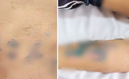 Tắm lá chữa sởi nam thanh niên viêm da bội nhiễm toàn thân