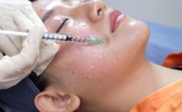 Tiêm meso bao lâu 1 lần là hợp lý? Tìm hiểu lịch trình chăm sóc da chuẩn khoa học cho làn da khỏe đẹp