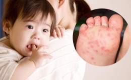 Nguyên nhân và dấu hiệu nhận biết tình trạng bệnh tay chân miệng ở trẻ