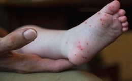 Tiến độ nghiên cứu vaccine tay chân miệng