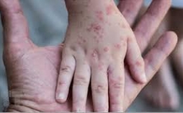 Những điều cần biết về bệnh đậu mùa khỉ hiện nay