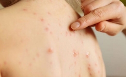 Bộ Y tế khuyến cáo người dân phòng bệnh sởi
