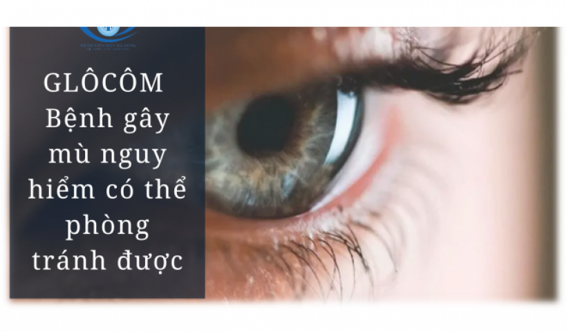 Cần kiểm tra mắt định kỳ để phát hiện sớm bệnh Glôcôm